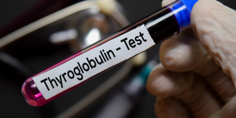Antikūnų prieš tireoglobuliną tyrimas