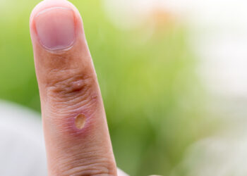 6 būdai, kaip nuimti žiedą nuo patinusio piršto