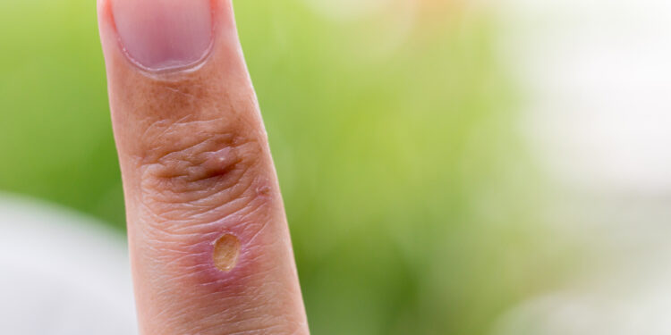 6 būdai, kaip nuimti žiedą nuo patinusio piršto