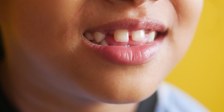 Kodėl kai kurie kūdikiai gimsta su dantimis