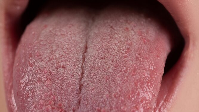 Viskas, ką turėtumėte žinoti apie išsišakojusį liežuvėlį