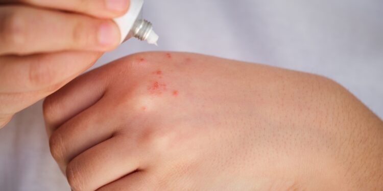 Ar galima išgydyti žvynelinę?