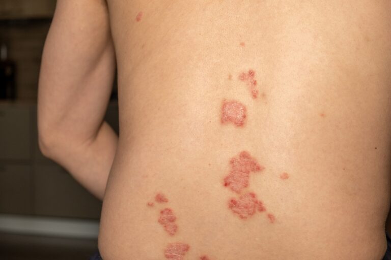 Psoriazės rizikos veiksniai