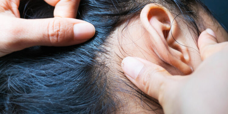 Kūno utėlių užkrėtimas