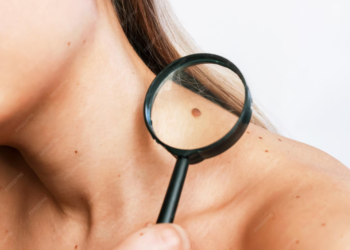 Apgamų šalinimas lazeriu: pasiruošimas procedūrai ir odos priežiūra po jos