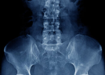 Ar rentgeno nuotraukoje galima pamatyti osteoporozę?