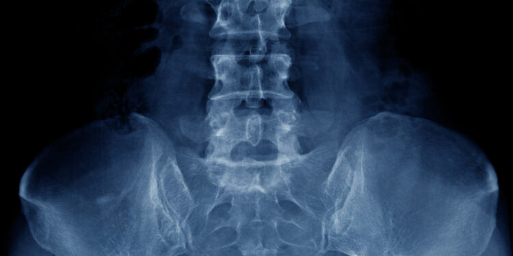 Ar rentgeno nuotraukoje galima pamatyti osteoporozę?