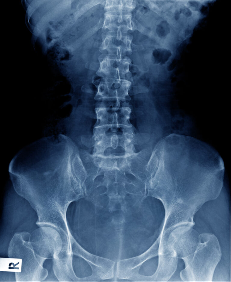 Ar rentgeno nuotraukoje galima pamatyti osteoporozę?