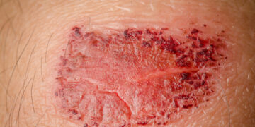 **Incruse Ellipta dozavimo informacija**