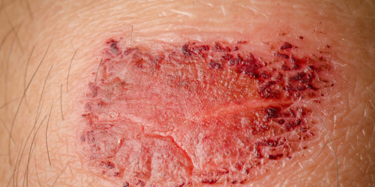 **Incruse Ellipta dozavimo informacija**