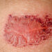 **Incruse Ellipta dozavimo informacija**