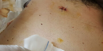 Ar tulžies pūslės pašalinimo operacija gali sutrikdyti hormonų pusiausvyrą?