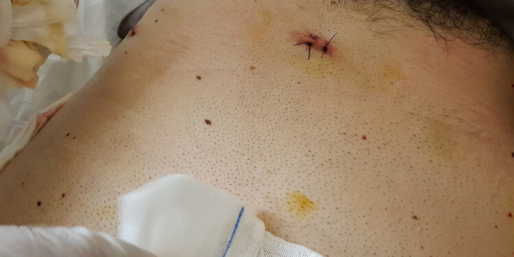 Ar tulžies pūslės pašalinimo operacija gali sutrikdyti hormonų pusiausvyrą?