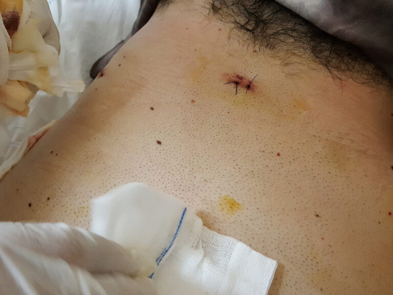Ar tulžies pūslės pašalinimo operacija gali sutrikdyti hormonų pusiausvyrą?