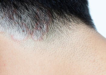 6 galimi būdai atsikratyti grybelio (odos grybelinės infekcijos)