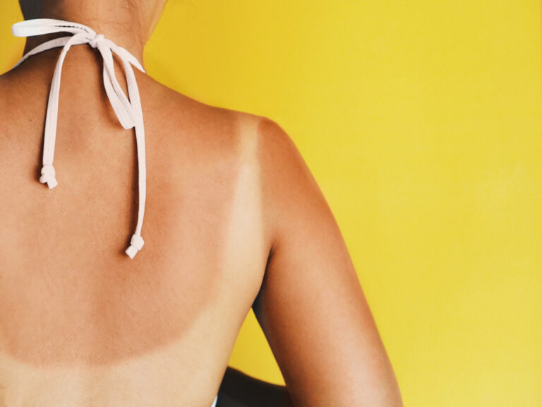 7 būdai, kaip gydyti nudegimą saulėje namuose