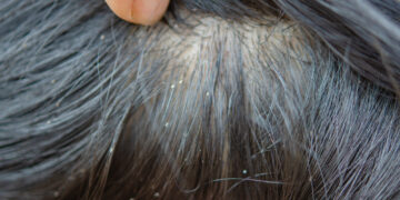 Kaip atskirti gyvas ir negyvas utėlių kiaušinėles (glindas)?