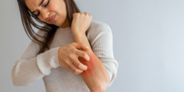 Ką reikėtų žinoti apie IgA nefropatiją ir odos bėrimus