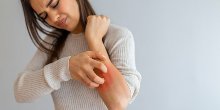 Ką reikėtų žinoti apie IgA nefropatiją ir odos bėrimus