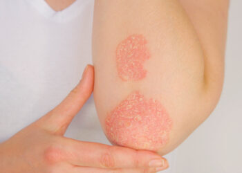 Kaip pedikiūras pakeitė mano santykį su psoriaze