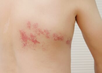 Ar galima susirgti lengva juostinės pūslelinės forma?