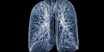 Plaučių vėžio simptomai