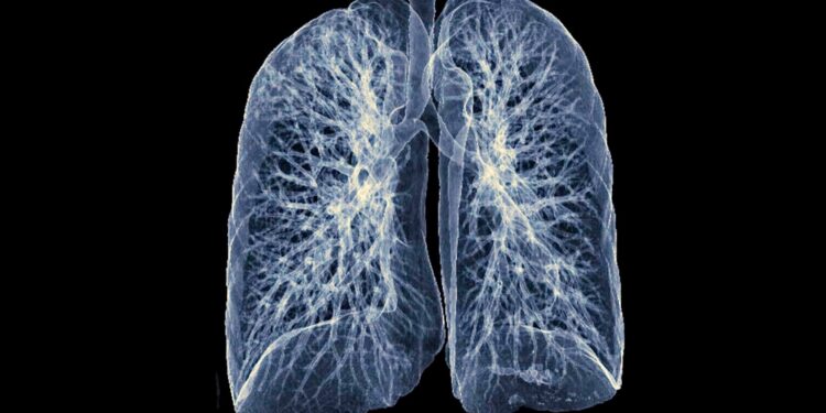 Plaučių vėžio simptomai