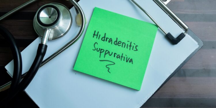 6 dalykai, galintys pabloginti pūlingą hidradenitą, ir kaip jų išvengti