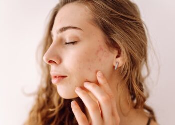 Idiopatinė kraniofacialinė eritema: veido raudonavimo priežastys ir valdymas