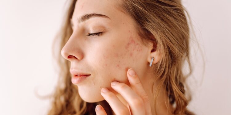 Idiopatinė kraniofacialinė eritema: veido raudonavimo priežastys ir valdymas