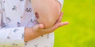 Ką daryti, kai šašas supūliuoja?