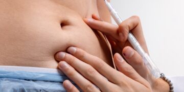 Ar liposakcija saugi?