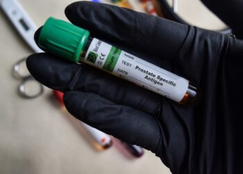 Prostatos specifinio antigeno (PSA) tyrimas: trukmė, rezultatai ir kita