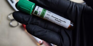 Prostatos specifinio antigeno (PSA) tyrimas: trukmė, rezultatai ir kita