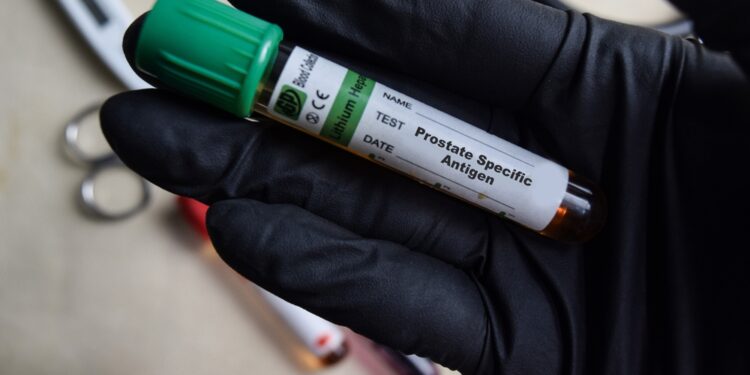 Prostatos specifinio antigeno (PSA) tyrimas: trukmė, rezultatai ir kita