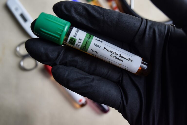 Prostatos specifinio antigeno (PSA) tyrimas: trukmė, rezultatai ir kita