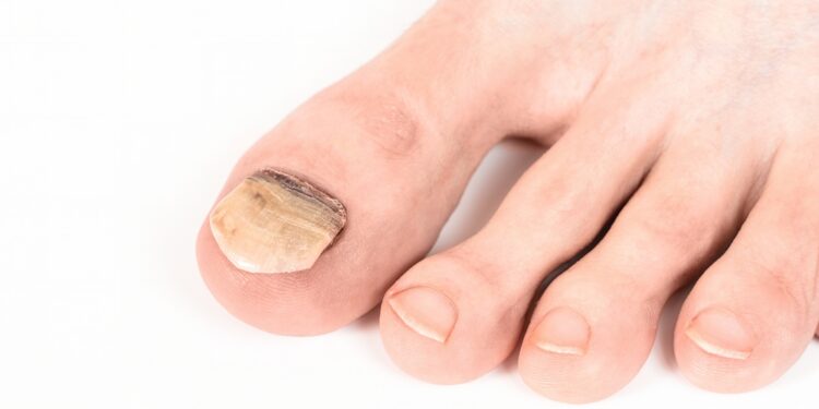 Diabetas ir geltoni nagai: ar yra ryšys?