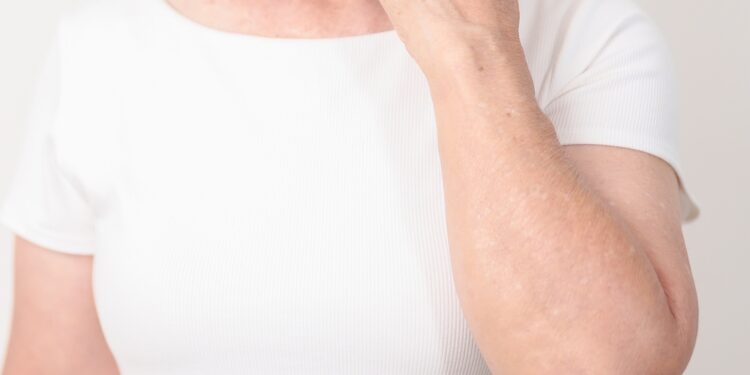 Kuo skiriasi raupsai ir žvynelinė?