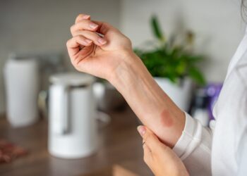 Vandens pūslių supratimas ir gydymas