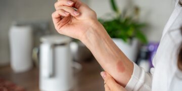 Vandens pūslių supratimas ir gydymas