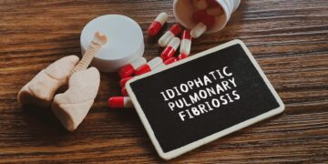 6 paslėpti IPF įspėjamieji požymiai