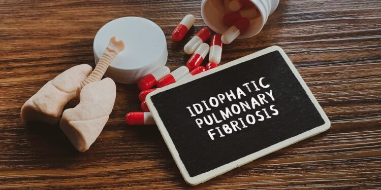 6 paslėpti IPF įspėjamieji požymiai