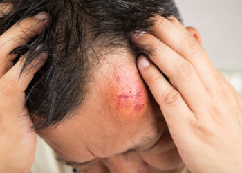 Ką reikėtų žinoti apie kaktos išsikišimą