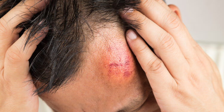 Ką reikėtų žinoti apie kaktos išsikišimą