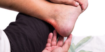 Ar podagra gali pasireikšti kulne?