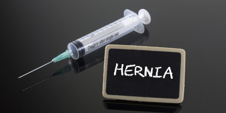 viršutinės pilvo dalies išvarža