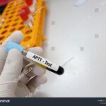 Aktyvuoto dalinio tromboplastino laiko (ADTL, PTT) tyrimas
