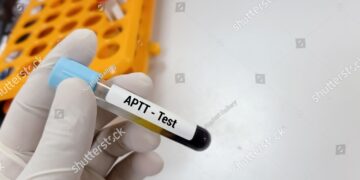 **Aktyvuoto dalinio tromboplastino laiko (ADTL, PTT) tyrimas**