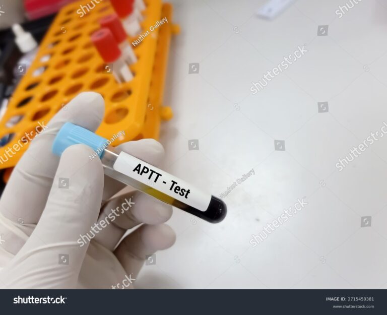 Aktyvuoto dalinio tromboplastino laiko (ADTL, PTT) tyrimas