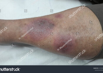 **Erythema Nodosum** lietuviškai: **Mazginė eritema**.